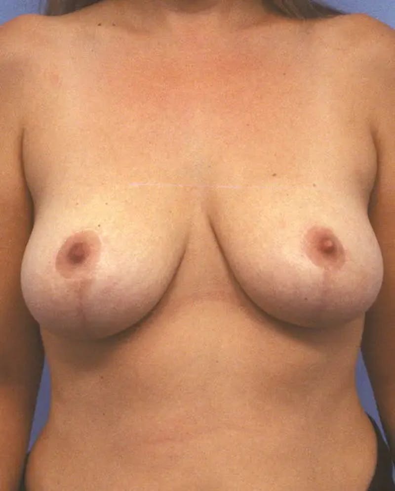 Breast Lift with Augmentation Before & After Gallery - Patient 251267 - Image 2