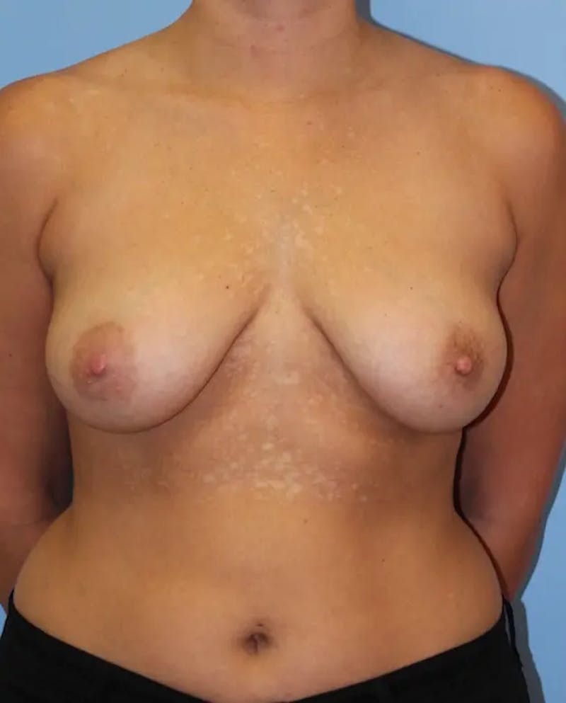 Breast Lift with Augmentation Before & After Gallery - Patient 137941 - Image 1