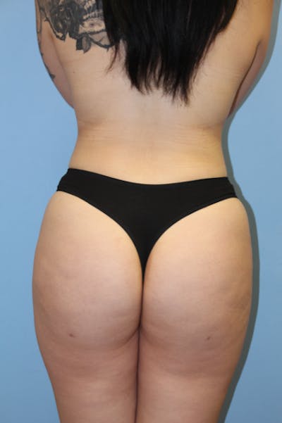 Brazilian Butt Lift Before & After Gallery - Patient 135808 - Image 2