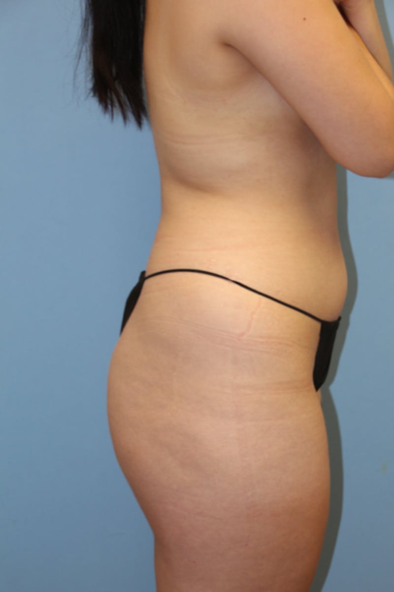 Brazilian Butt Lift Before & After Gallery - Patient 135808 - Image 3