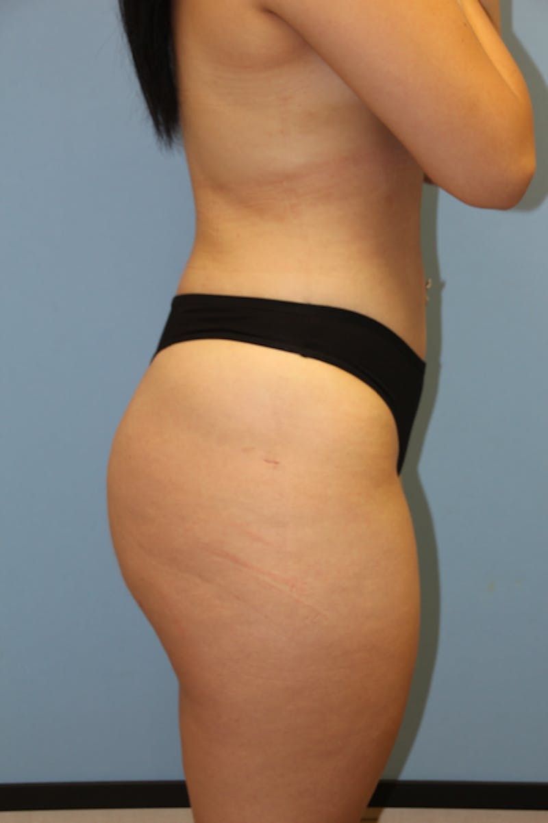Brazilian Butt Lift Before & After Gallery - Patient 135808 - Image 4