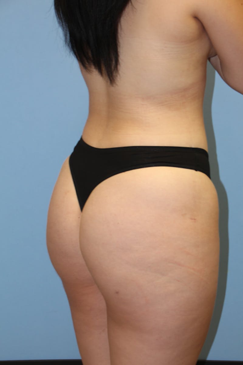 Brazilian Butt Lift Before & After Gallery - Patient 135808 - Image 6