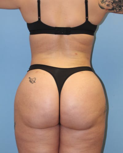 Brazilian Butt Lift Before & After Gallery - Patient 131410 - Image 2