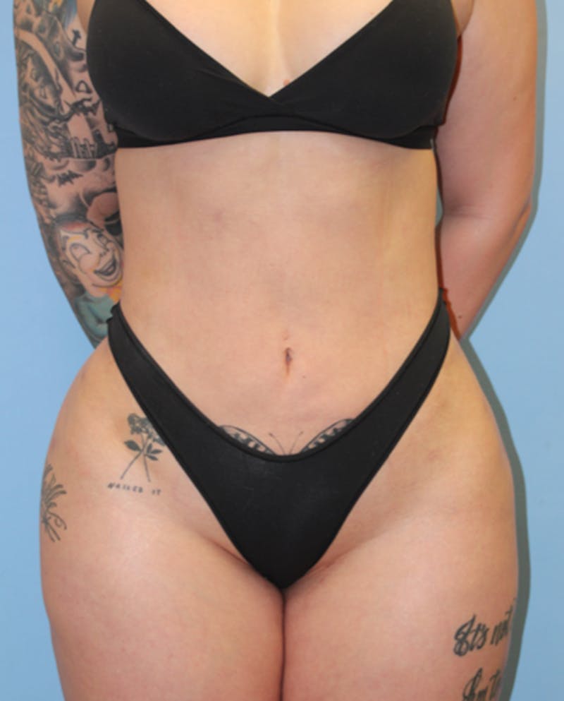 Brazilian Butt Lift Before & After Gallery - Patient 131410 - Image 4
