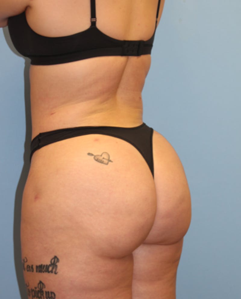 Brazilian Butt Lift Before & After Gallery - Patient 131410 - Image 6