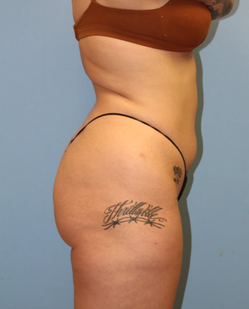 Brazilian Butt Lift Before & After Gallery - Patient 131410 - Image 7