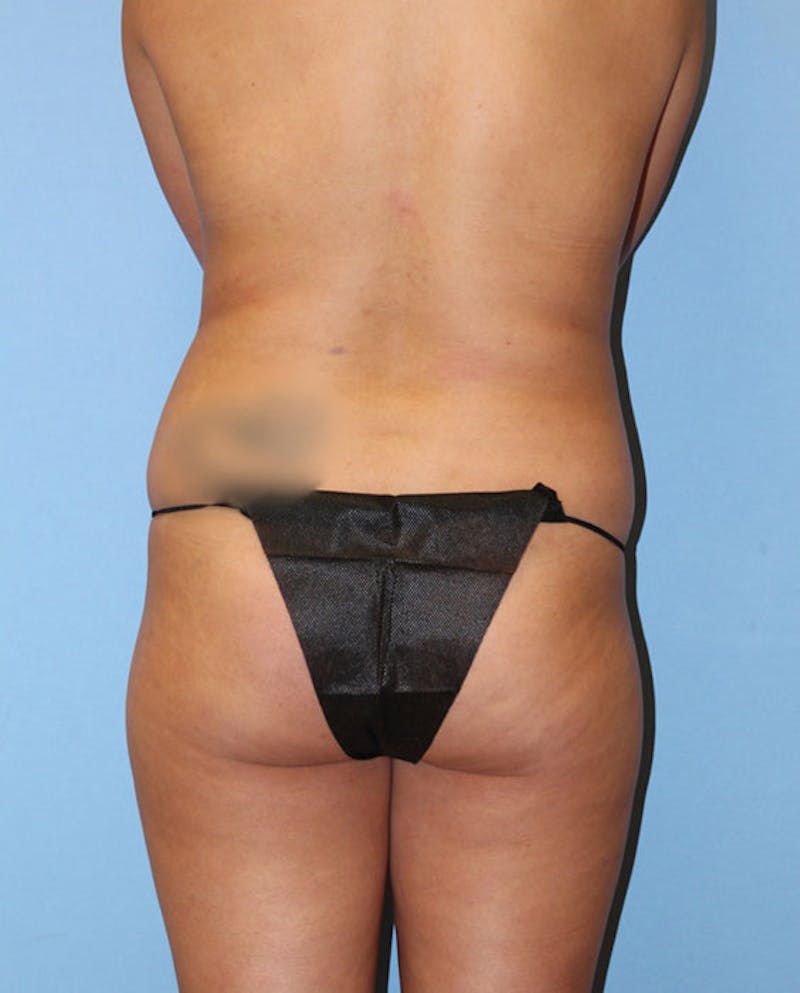 Brazilian Butt Lift Before & After Gallery - Patient 443189 - Image 1