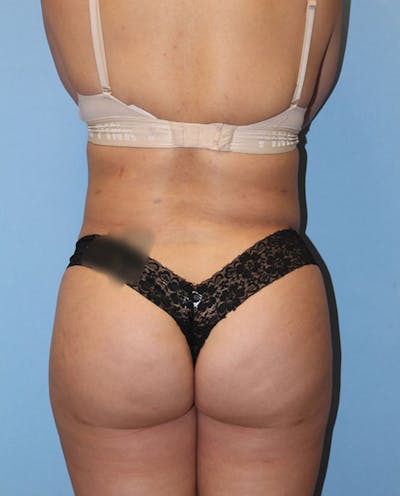 Brazilian Butt Lift Before & After Gallery - Patient 443189 - Image 2