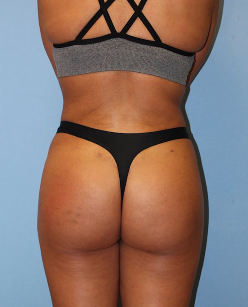 Brazilian Butt Lift Before & After Gallery - Patient 819112 - Image 2