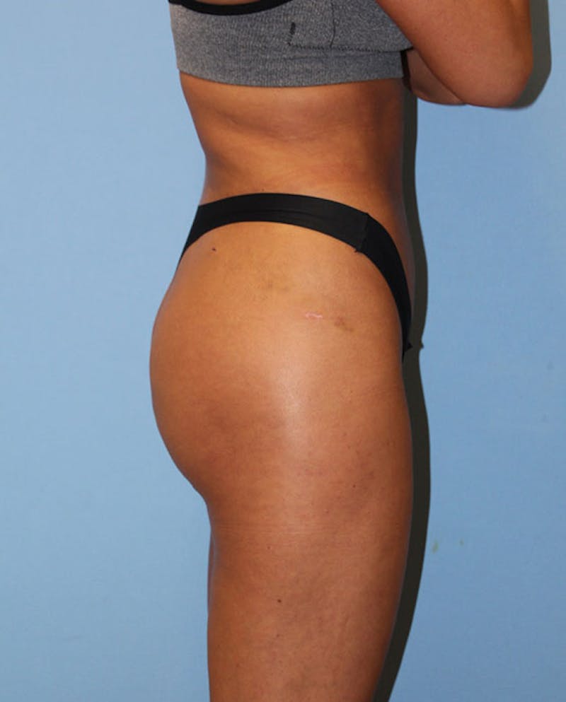 Brazilian Butt Lift Before & After Gallery - Patient 819112 - Image 4