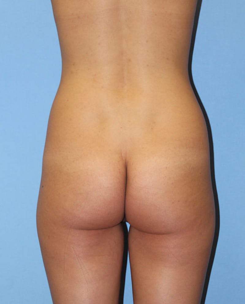 Brazilian Butt Lift Before & After Gallery - Patient 305841 - Image 1