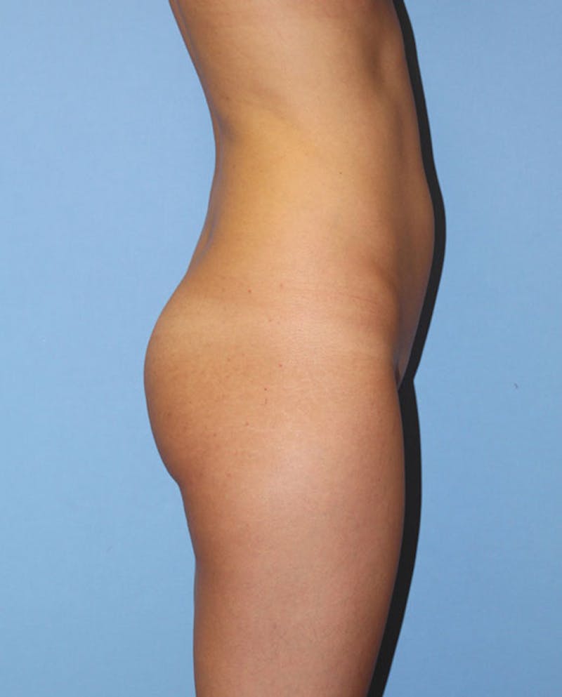 Brazilian Butt Lift Before & After Gallery - Patient 305841 - Image 5
