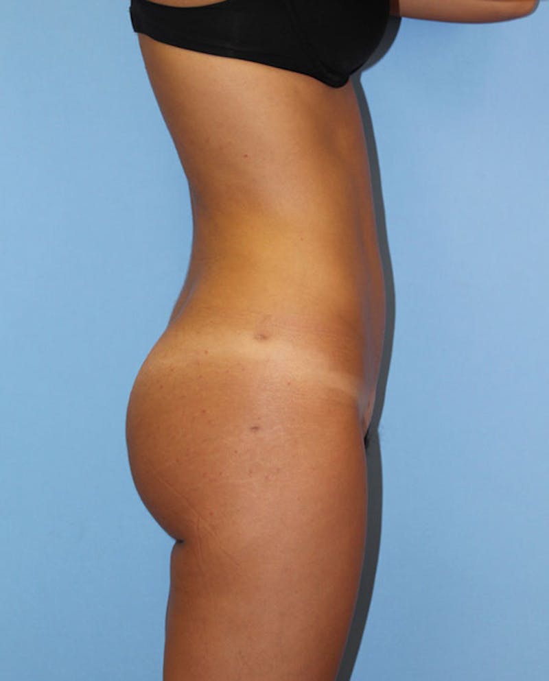 Brazilian Butt Lift Before & After Gallery - Patient 305841 - Image 6
