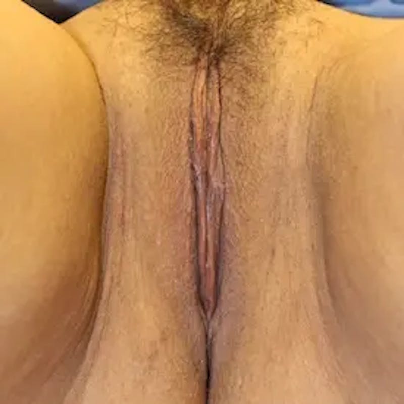 Vaginal Rejuvenation Before & After Gallery - Patient 763519 - Image 2