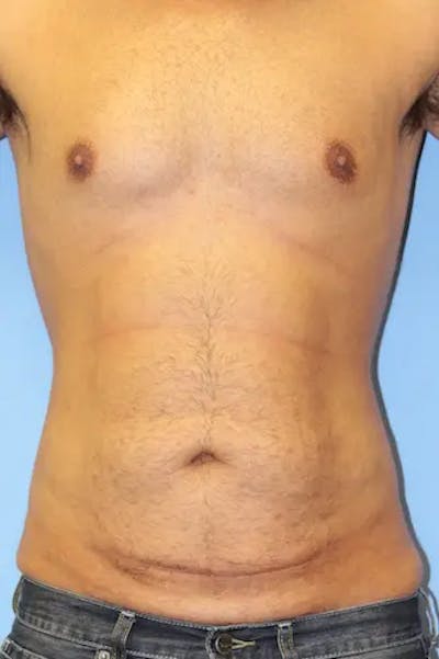 Tummy Tuck Before & After Gallery - Patient 242317 - Image 1