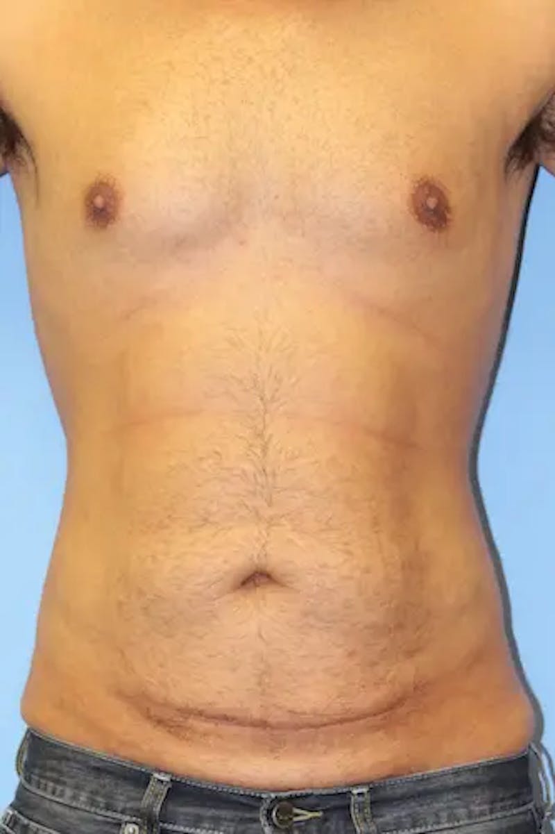 Tummy Tuck Before & After Gallery - Patient 242317 - Image 1