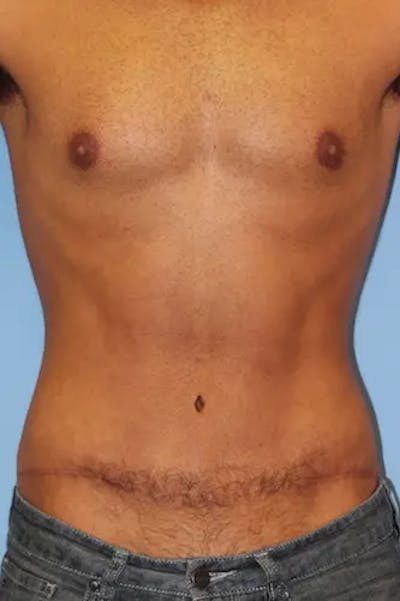 Tummy Tuck Before & After Gallery - Patient 242317 - Image 2