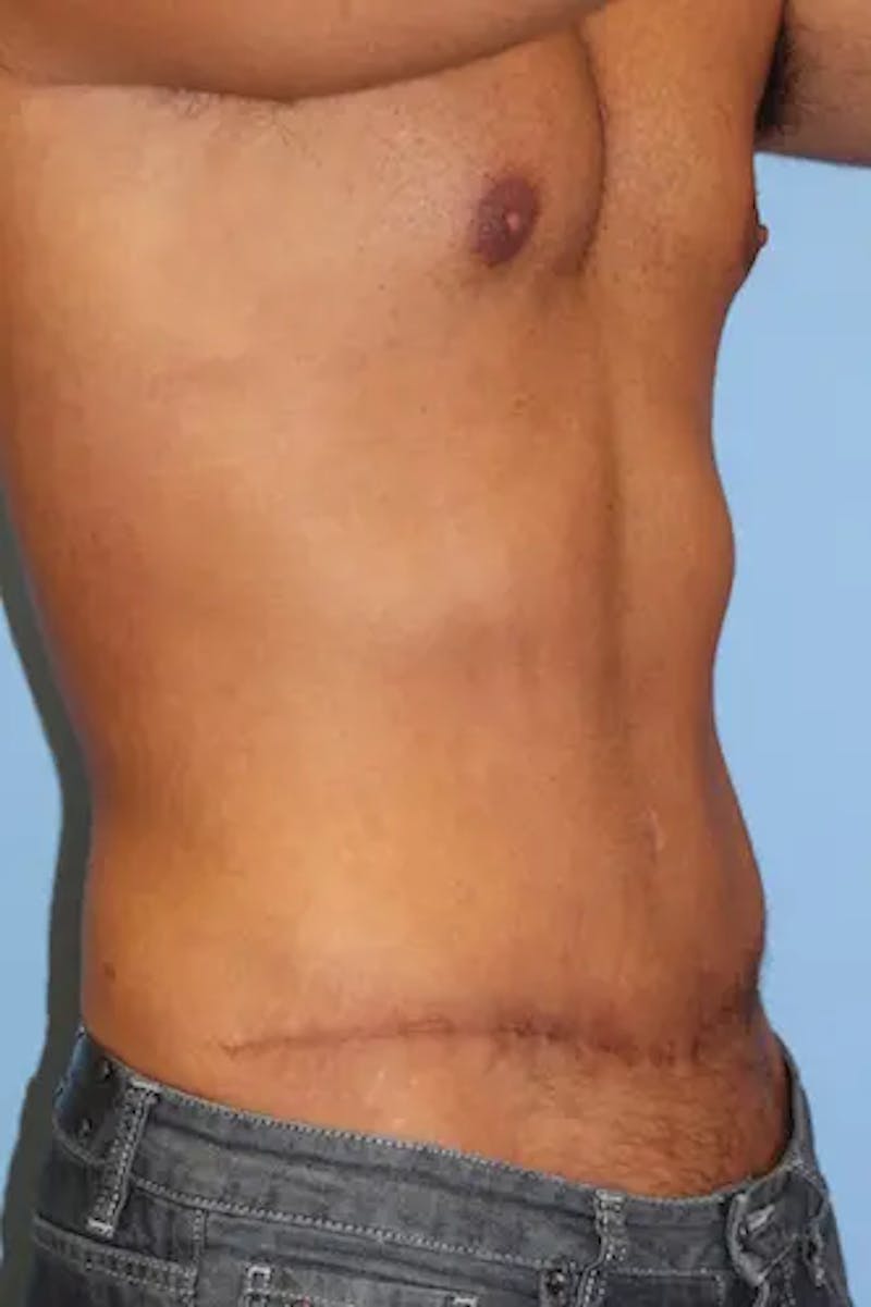 Tummy Tuck Before & After Gallery - Patient 242317 - Image 4