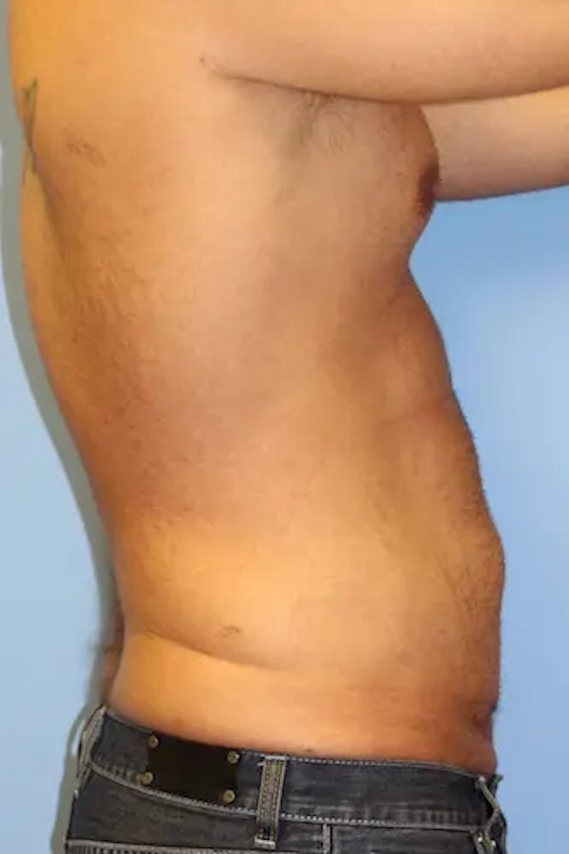 Tummy Tuck Before & After Gallery - Patient 242317 - Image 5