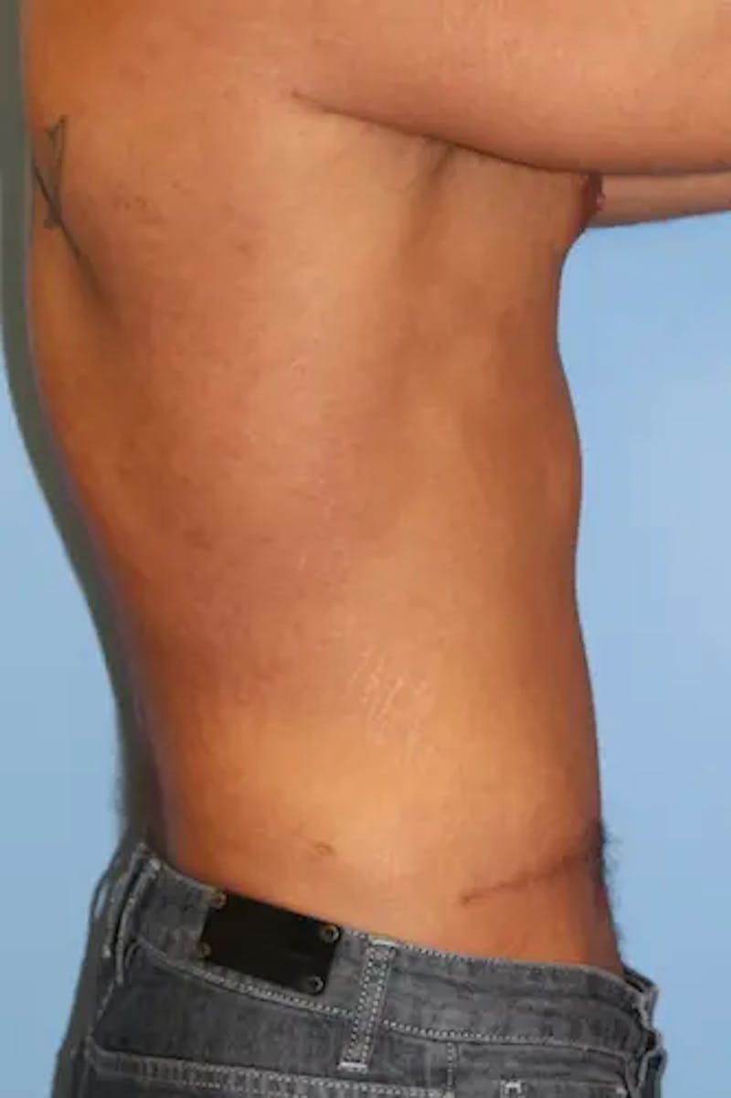 Tummy Tuck Before & After Gallery - Patient 242317 - Image 6