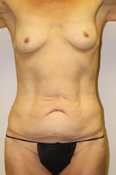 Tummy Tuck Before & After Gallery - Patient 298695 - Image 1