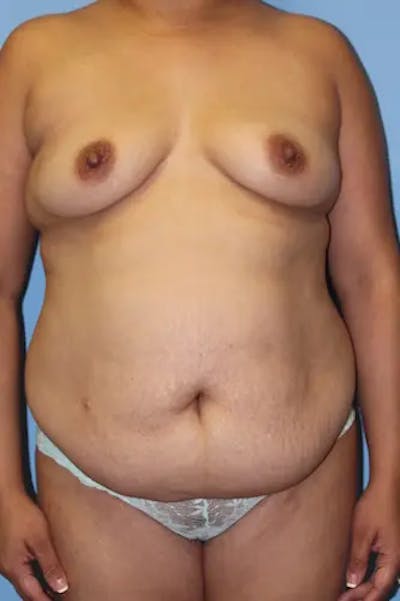 Tummy Tuck Before & After Gallery - Patient 104091 - Image 1