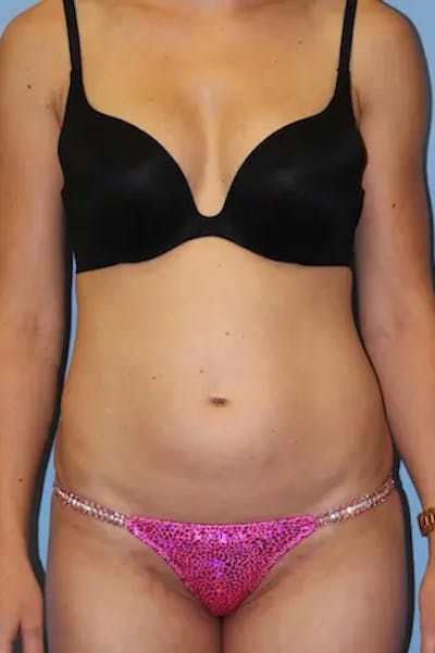 Tummy Tuck Before & After Gallery - Patient 918413 - Image 1