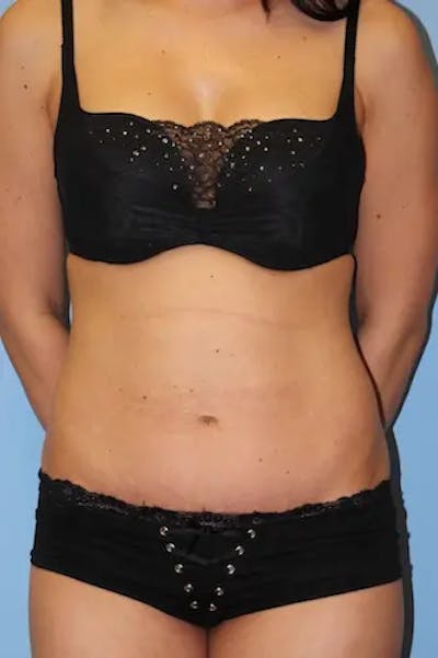 Tummy Tuck Before & After Gallery - Patient 918413 - Image 2