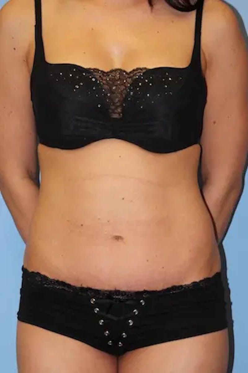 Tummy Tuck Before & After Gallery - Patient 918413 - Image 2