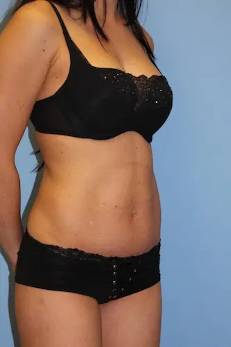 Tummy Tuck Before & After Gallery - Patient 918413 - Image 4