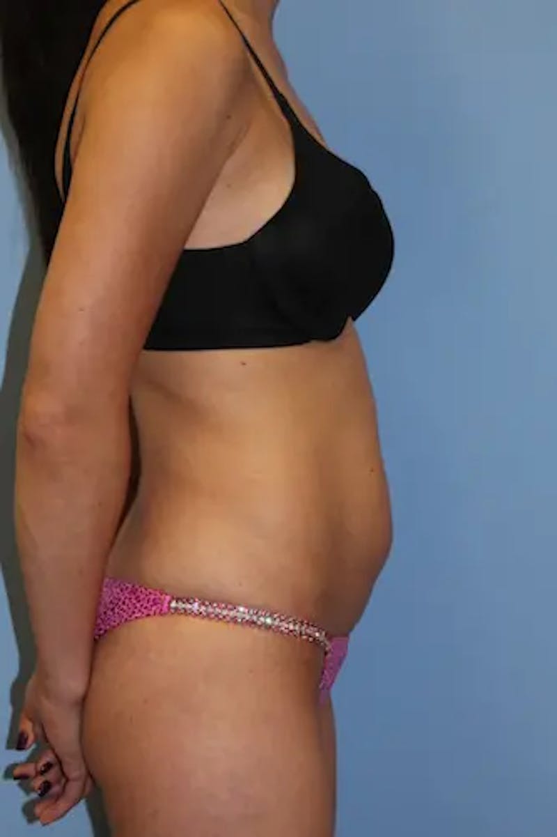 Tummy Tuck Before & After Gallery - Patient 918413 - Image 5