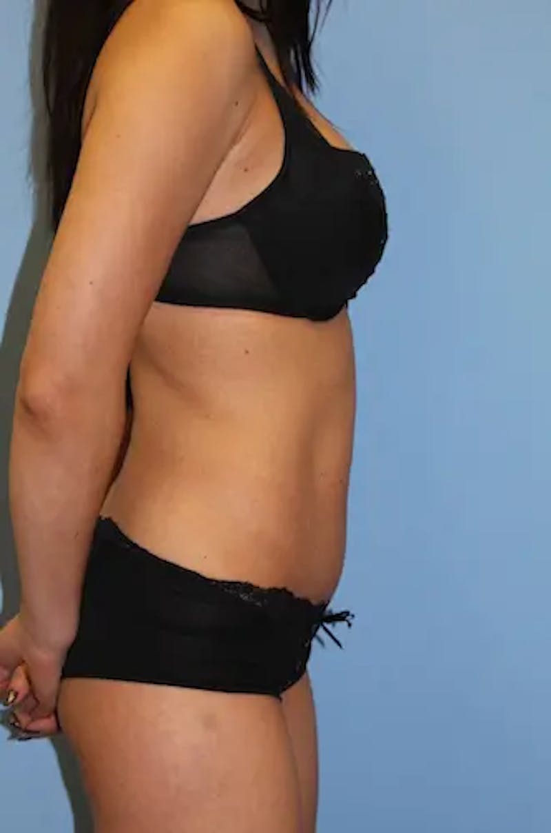 Tummy Tuck Before & After Gallery - Patient 918413 - Image 6