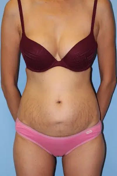 Tummy Tuck Before & After Gallery - Patient 190059 - Image 1