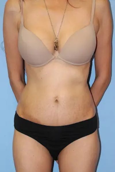 Tummy Tuck Before & After Gallery - Patient 190059 - Image 2