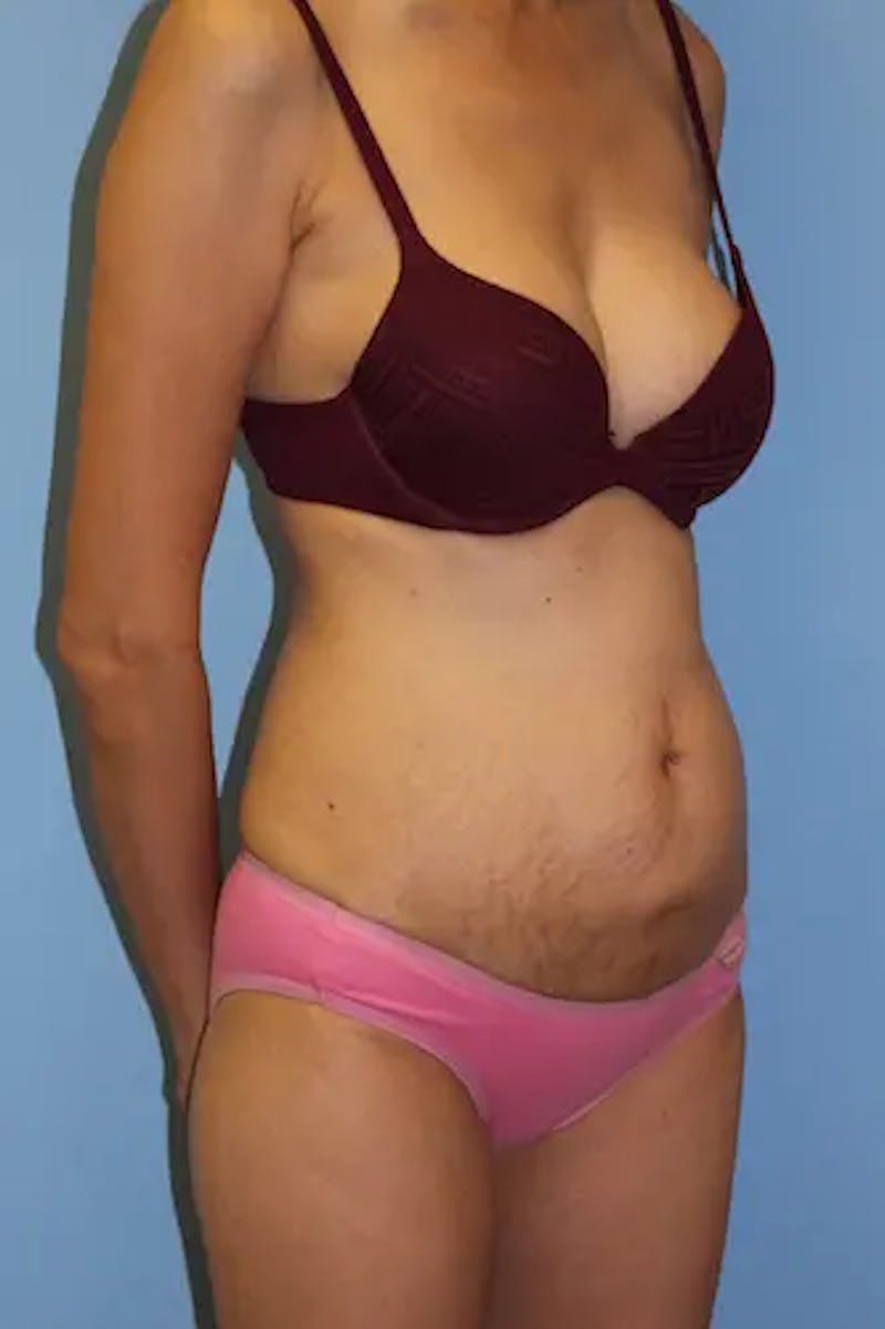Tummy Tuck Before & After Gallery - Patient 190059 - Image 3