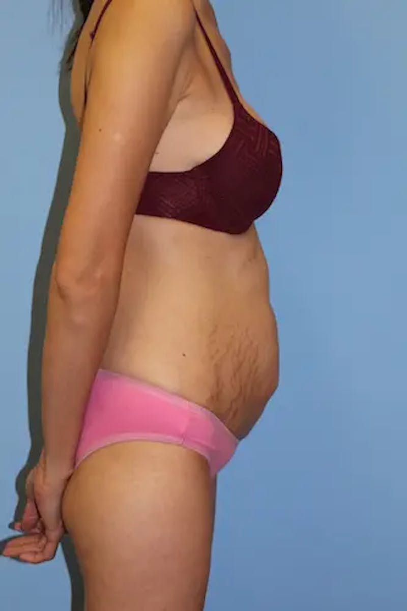 Tummy Tuck Before & After Gallery - Patient 190059 - Image 5
