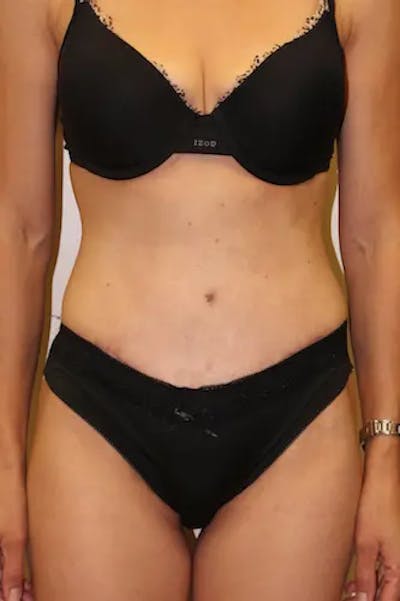 Tummy Tuck Before & After Gallery - Patient 301997 - Image 2