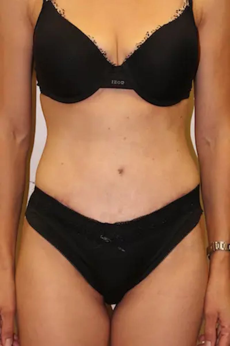 Tummy Tuck Before & After Gallery - Patient 301997 - Image 2