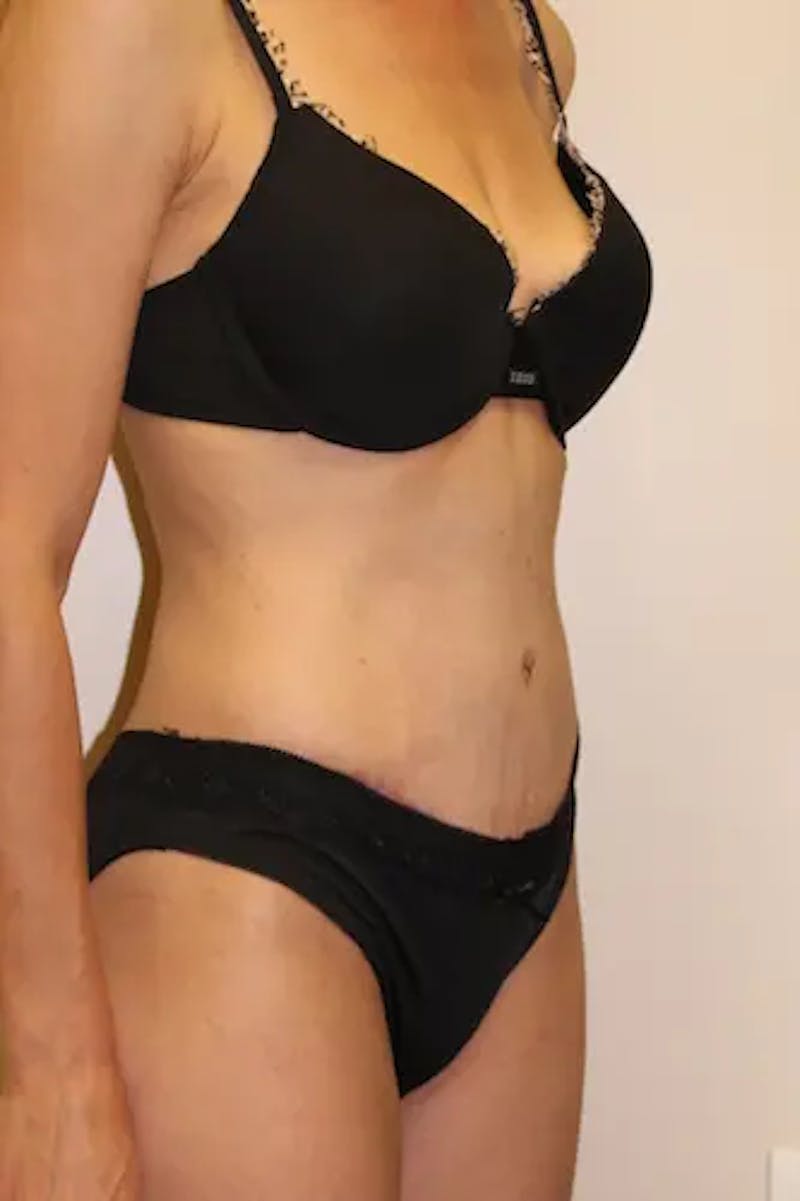 Tummy Tuck Before & After Gallery - Patient 301997 - Image 4