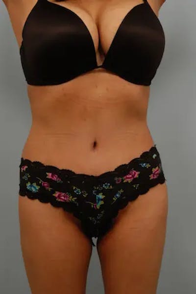 Tummy Tuck Before & After Gallery - Patient 356997 - Image 2