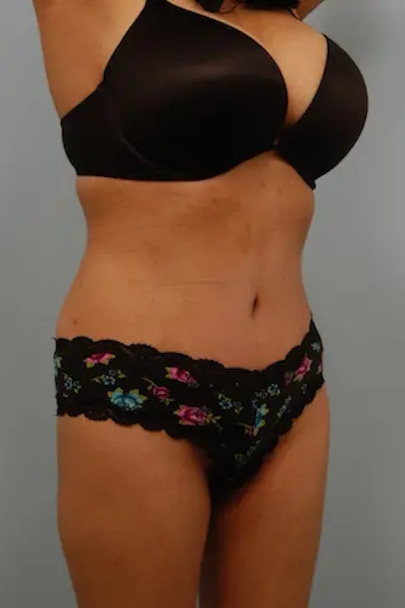 Tummy Tuck Before & After Gallery - Patient 356997 - Image 4