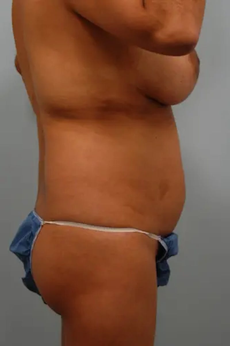 Tummy Tuck Before & After Gallery - Patient 356997 - Image 5