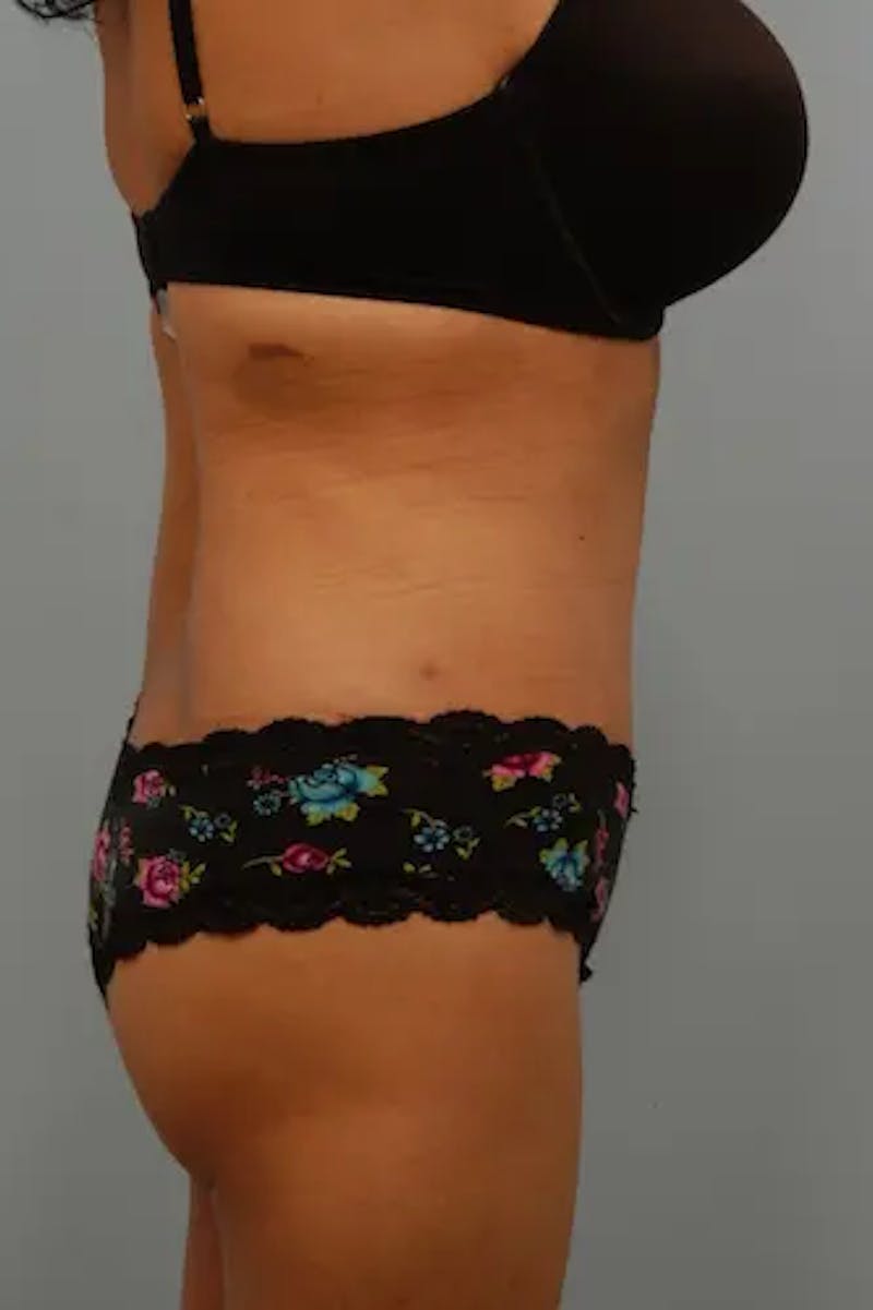 Tummy Tuck Before & After Gallery - Patient 356997 - Image 6