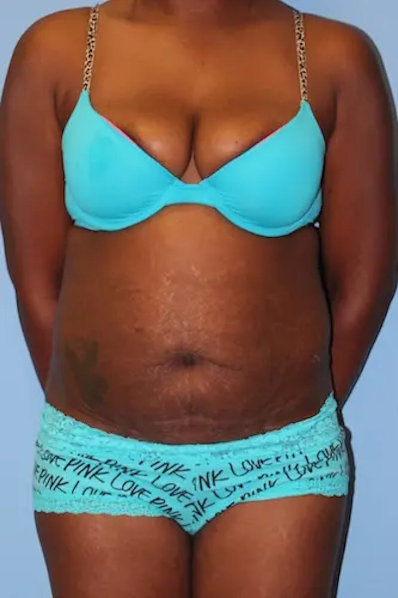 Tummy Tuck Before & After Gallery - Patient 324376 - Image 1