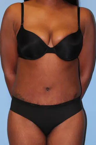 Tummy Tuck Before & After Gallery - Patient 324376 - Image 2