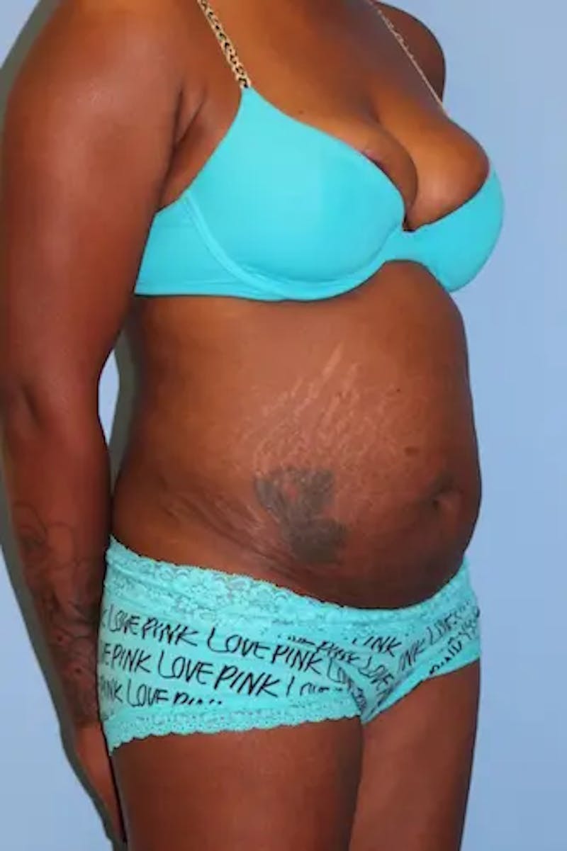 Tummy Tuck Before & After Gallery - Patient 324376 - Image 3