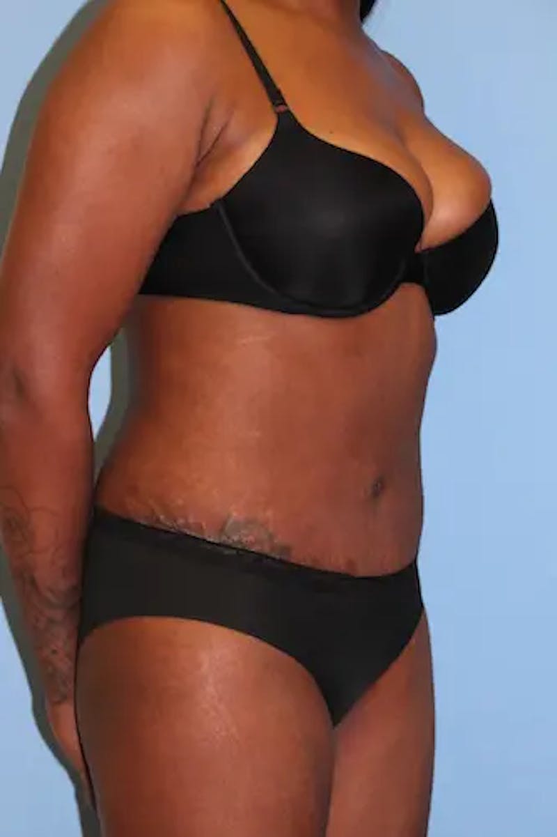 Tummy Tuck Before & After Gallery - Patient 324376 - Image 4