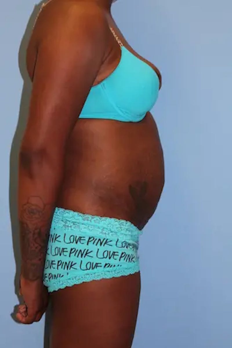 Tummy Tuck Before & After Gallery - Patient 324376 - Image 5