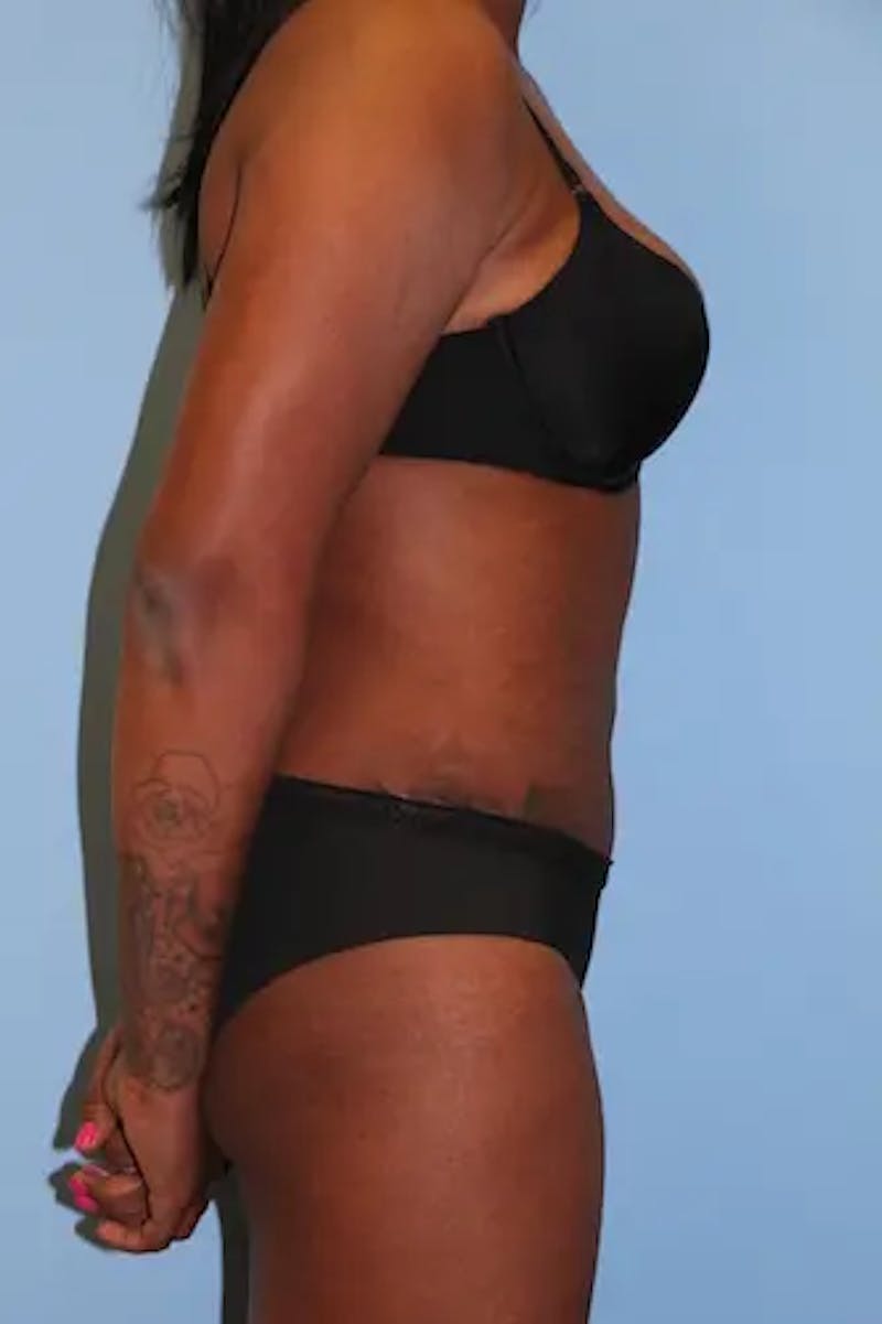 Tummy Tuck Before & After Gallery - Patient 324376 - Image 6