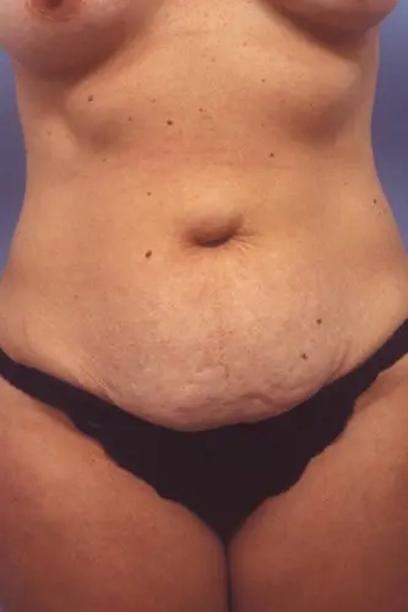 Tummy Tuck Before & After Gallery - Patient 205861 - Image 1